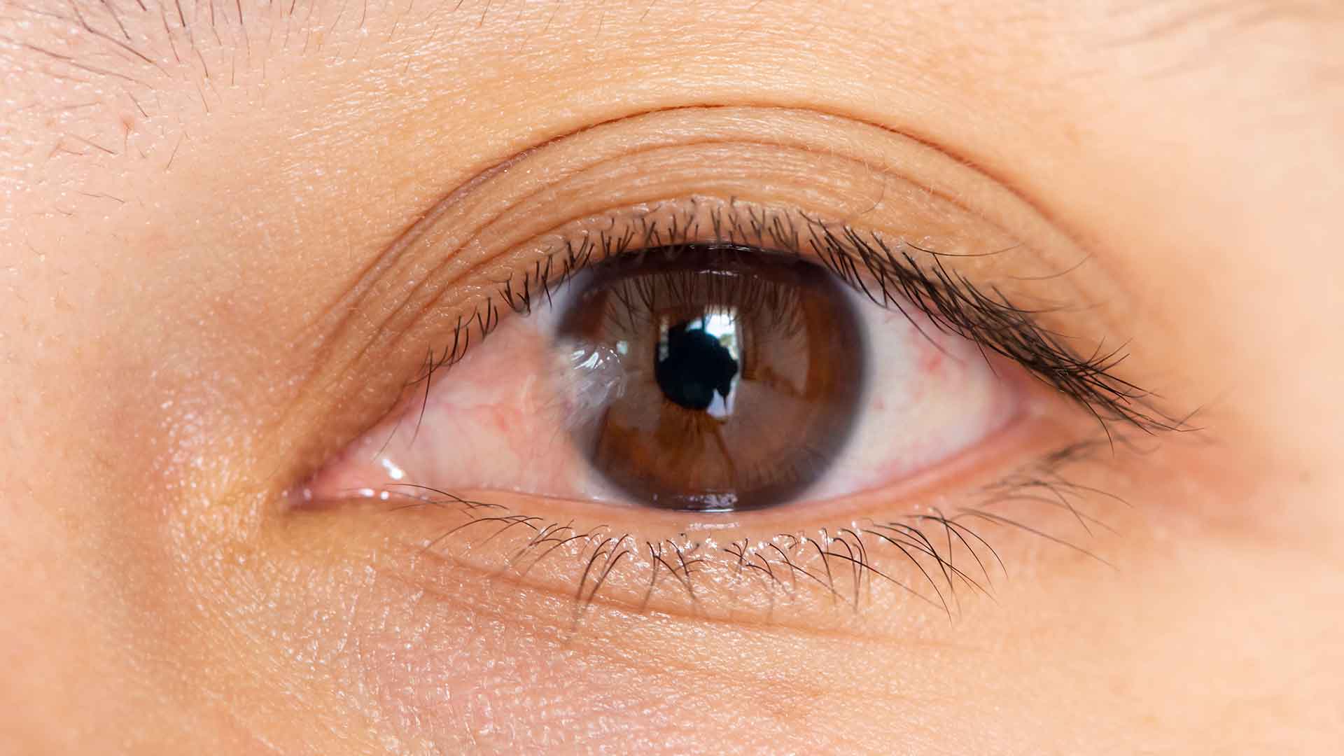 Pterygium