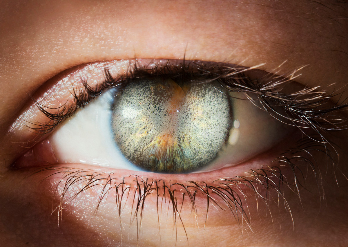 Corneal Dystrophies